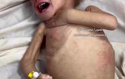 Thumbnail preview image for the video titled: Three-year-old Maryam Abdullah Abu Daqa suffers severe malnutrition due to the Gaza siege