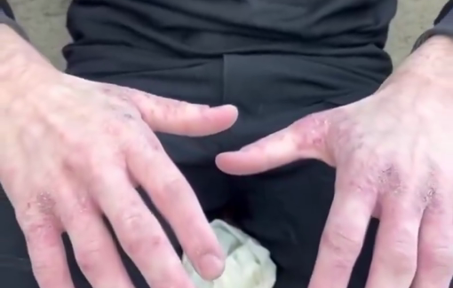 Thumbnail preview image for the video titled: Released prisoner Bakr Fayid from Jenin, Palestine, shows hands covered in scabies