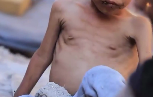 Thumbnail preview image for the video titled: Children in Gaza are facing a growing crisis of disease and malnutrition, with flies swarming overcrowded shelters and hospitals