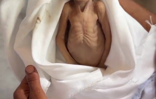 Thumbnail preview image for the video titled: Baby Ghadir Breika dies from malnutrition exacerbating her underlying condition